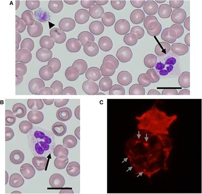 Case Report: MYH9-related disease caused by Ala44Pro mutation in a child with a previous diagnosis of chronic immune thrombocytopenia